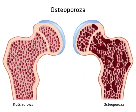 osteoporoza co to
