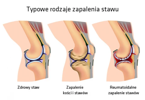 artroza kolana leczenie naturalne)