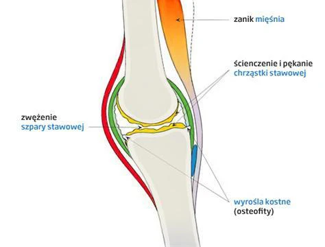Deformáló artrózis a könyökízület tünetei - Az alsó végtagi ízületi gyulladás