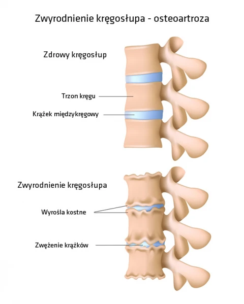 Tot ce trebuie sa stii despre ARTROZA: simptome, cauze, tratament Tratamentul artrozei în taganrog